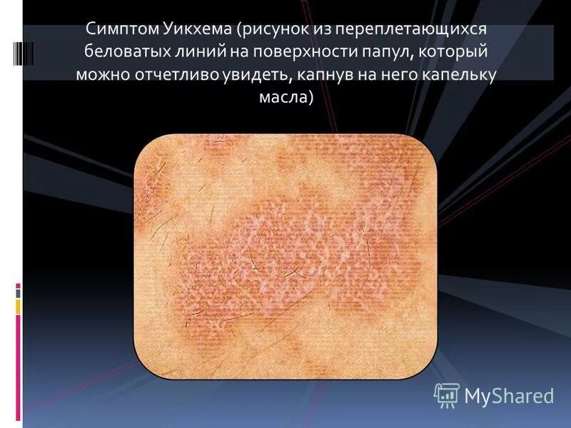 Красный бородавчатый лишай как выглядит Красный плоский лишай на коже фото - ViktoriaFoto.ru