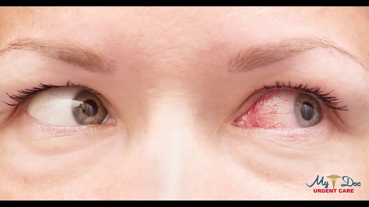 Красный глаз причины фото Urgent Care Bergen Passaic County NJ Pink Eye - YouTube