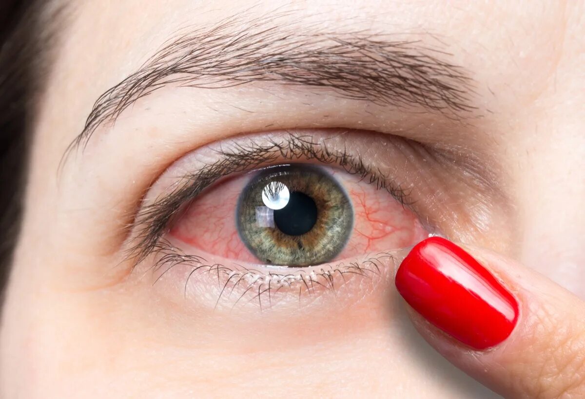 Красный глаз причины фото Signs You Have a Breakthrough Infection After Vaccination