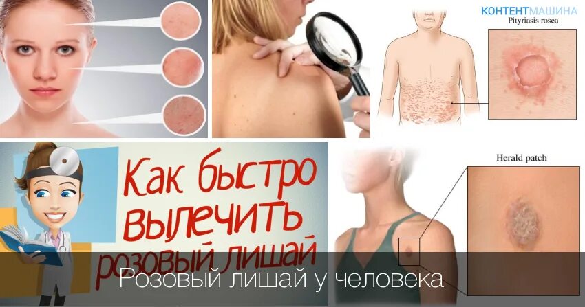 Красный лишай фото описание Розовый лишай у собаки: симптомы и лечение причины