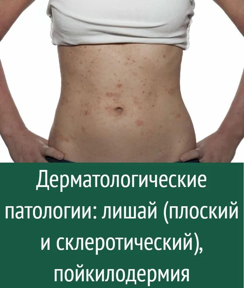 Красный лишай лечение фото Здоровье