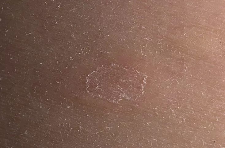 Красный лишай на коже как выглядит Шершавые коричневые