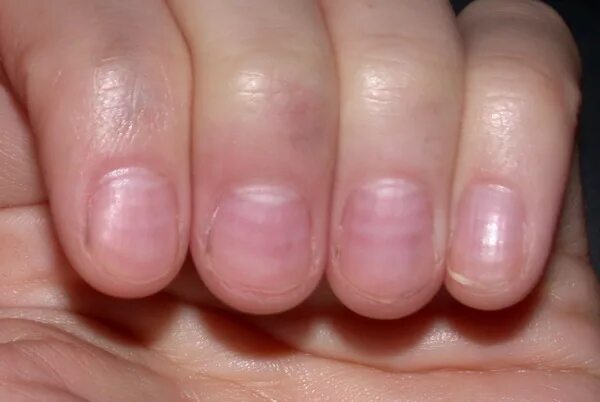Красный лишай на ногтях фото Muehrcke's nails - Wikipedia