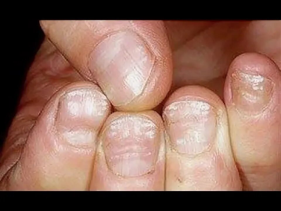 Красный лишай на ногтях фото White Stains or White Marks on your Toenails? Home Treatment Guide - YouTube