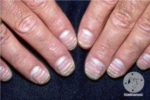 Красный лишай на ногтях фото Nails (Physical Assessment) Flashcards Quizlet