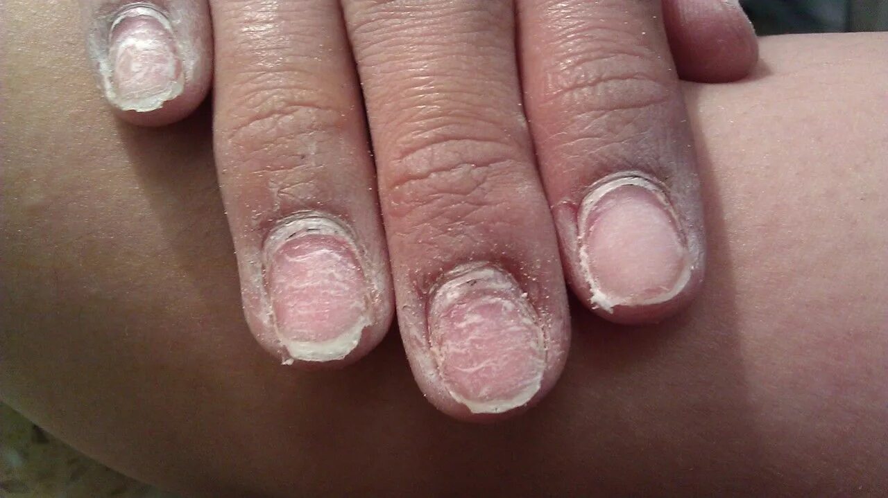Красный лишай на ногтях фото What 10 years of wearing gel/acrylic do to your nails xoxo Emmy Gel nails pictur