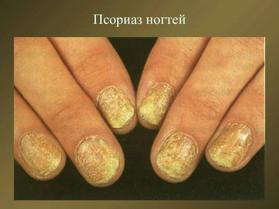 Красный лишай на ногтях фото Псориатическая ониходистрофия Дерматолог Галина Меньщикова Дзен