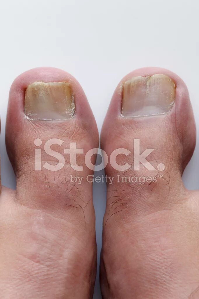 Красный лишай на ногтях фото Foto De Stock Onicomicosis Hongos Infección En Las Uñas Libre De Derechos FreeIm