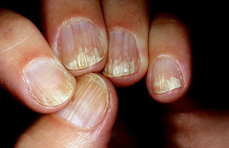 Красный лишай на ногтях фото Onychodystrophy. Changing the shape of nails. Photo.