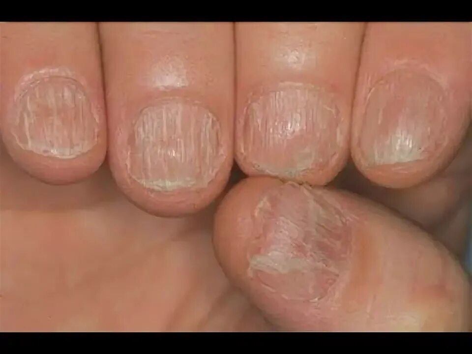 Красный лишай на ногтях фото Causa y Solucion en lineas en las uñas - YouTube