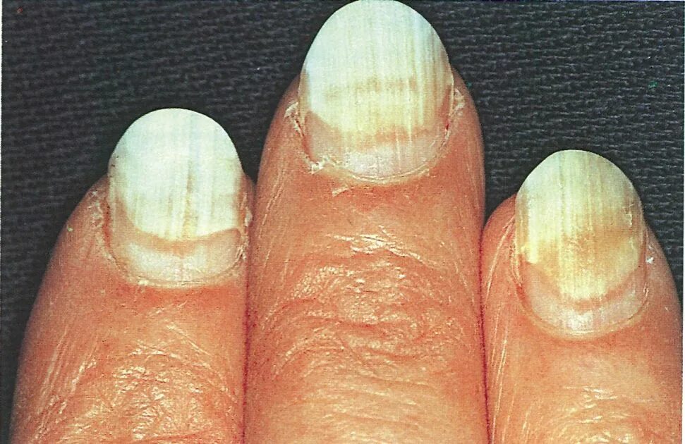 Красный лишай на ногтях фото Nail Separation Anxiety - Wellness - NAILS Magazine