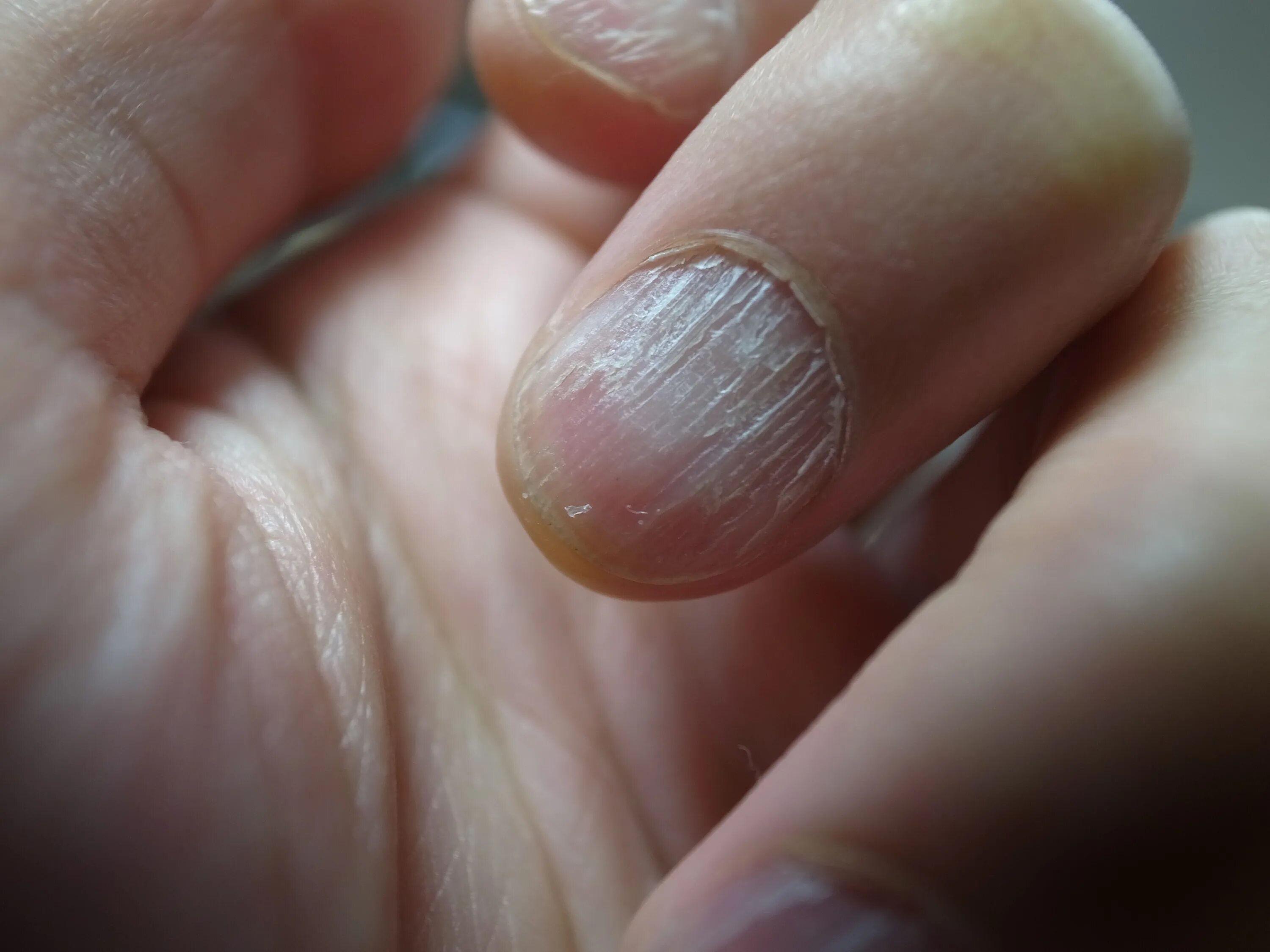 Красный лишай на ногтях фото Hair Like Pieces Of Skin Around Fingernails Best Sale www.beztabaka.by