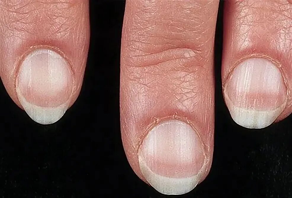 Красный лишай на ногтях фото Clues about your health, from your fingernails. Interesting to know, Fingernail 