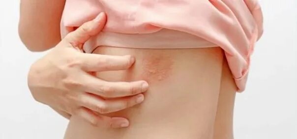 Красный опоясывающий лишай причины и лечение фото The treatment of snoring. Deprive the shingles (herpes zoster) causing the chick
