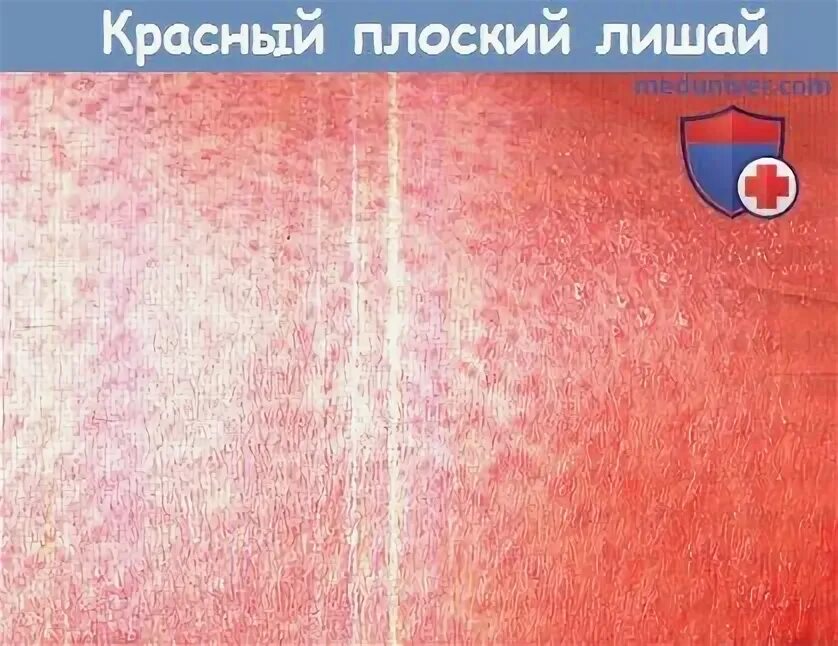 Красный плоский лишай фото слизистая Симптомы и клиника красного плоского лишая