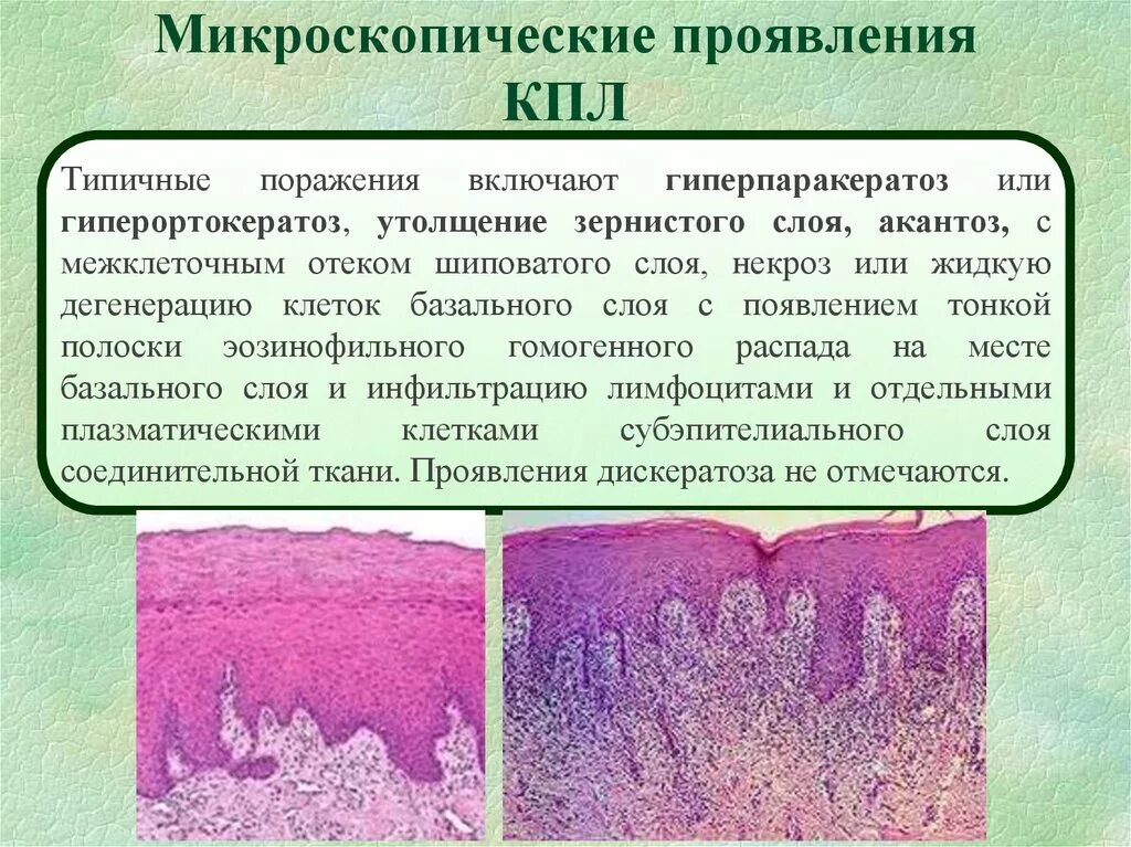 Красный плоский лишай фото слизистая Красный плоский лишай - презентация онлайн