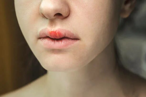 Красный плоский лишай на губах фото Более 80 работ на тему "Herpes Scabs": стоковые фото, картинки и изображения roy