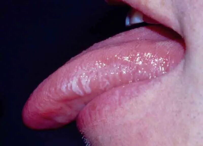 Красный плоский лишай на губах фото Question 1 - Oral Manifestations Question Bank - National HIV Curriculum