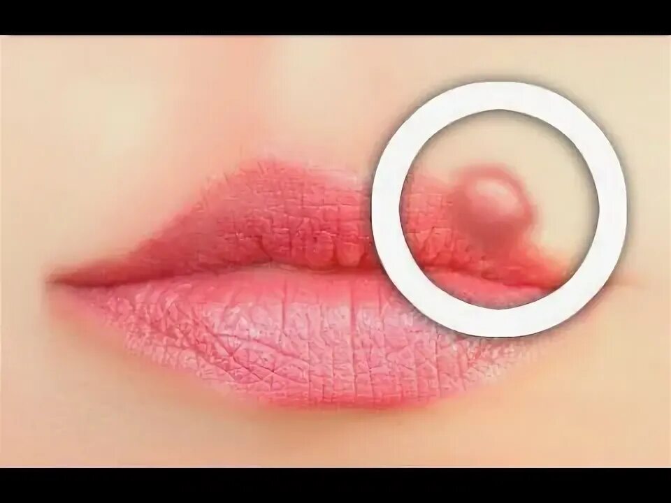 Красный плоский лишай на губах фото Hoe koortsblaasjes vermijden? - YouTube