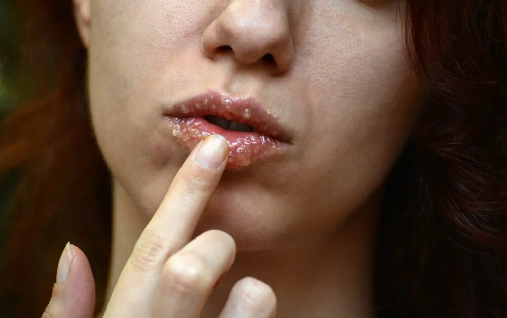 Красный плоский лишай на губах фото Lip Lines: 13 Best Treatments for Lip Wrinkles Colorescience