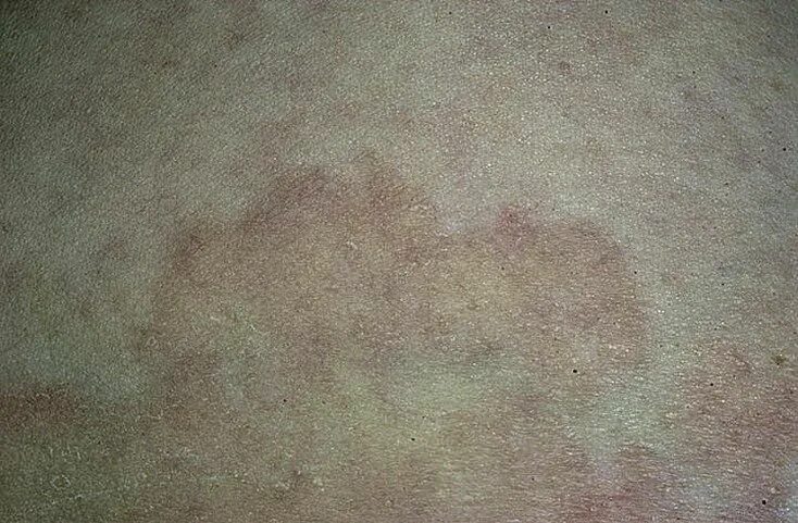 Красный плоский лишай на коже фото Malassezia furfur и разноцветный лишай: Фотоиллюстрации Мир вокруг нас Фотогалер