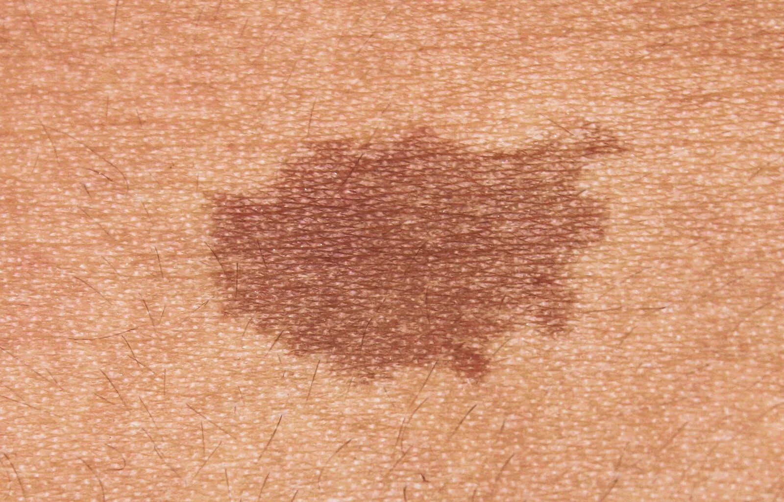 Красный плоский лишай на коже фото Cost of Hyperpigmentation Treatments - Options, Results, etc.