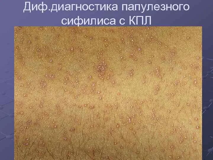 Красный плоский лишай на лице фото Пробковая болезнь eCookie.ru