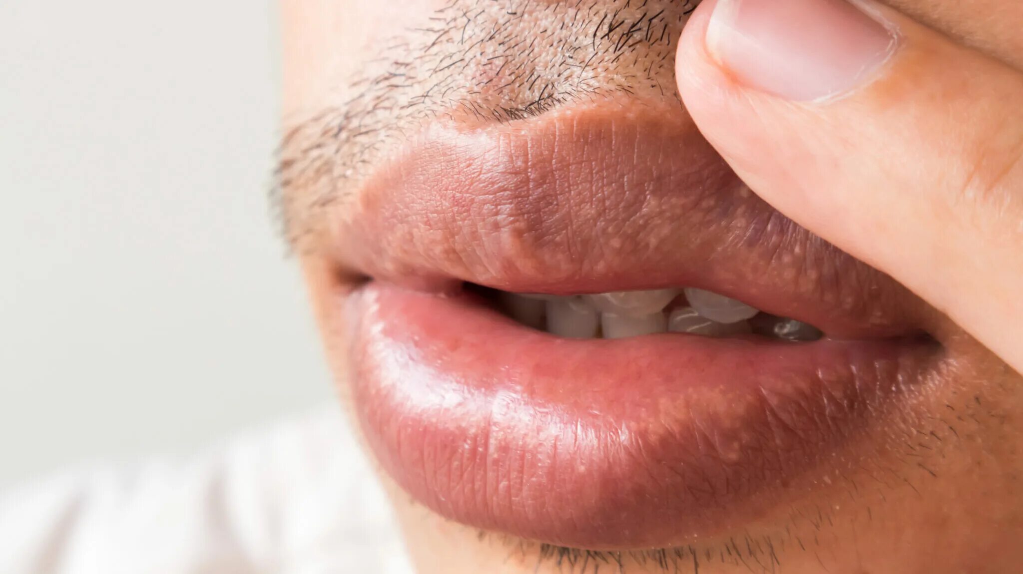 Красный плоский лишай на половых губах фото Oral Health Conditions
