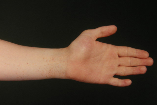 Красный плоский лишай на запястье фото Блестящий лишай - Dermatologo konsultacija internetu