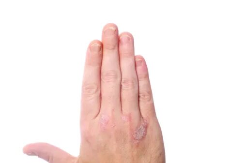 Красный плоский лишай на запястье фото Psoriatic arthritis patients are at a higher risk of heart problems