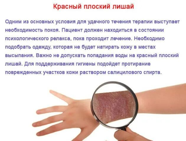 Красный плоский лишай у человека фото Красный лишай - 90 фото и видео инструкции по лечению в домашних условиях