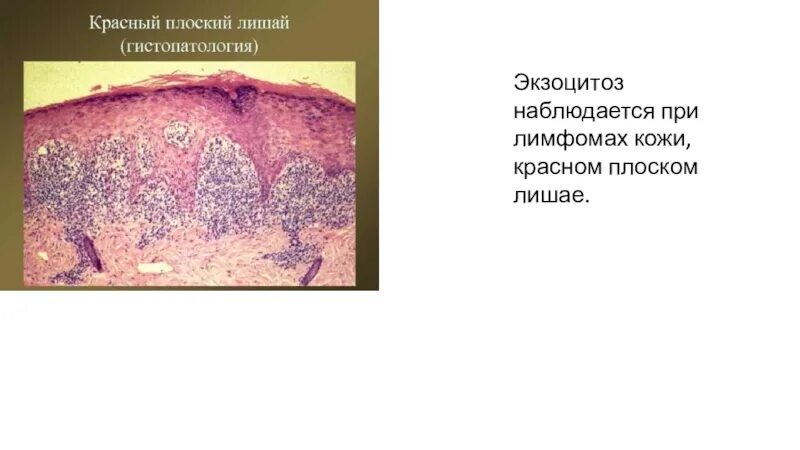 Красный плоский лишай у детей фото Текст слайда презентация, доклад