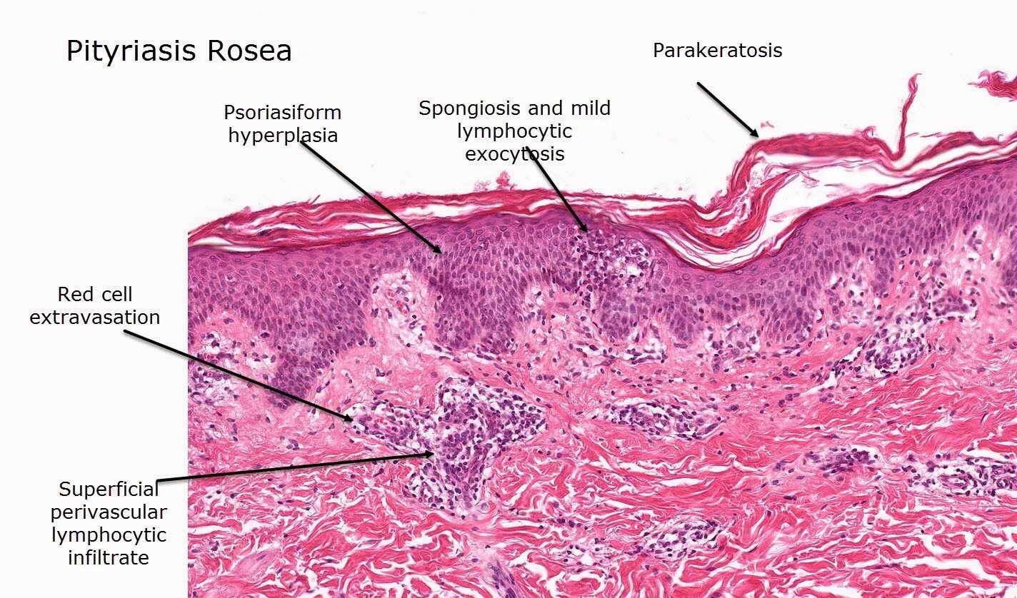 Красный плоский лишай вульвы фото Dermatopathology Made Simple - Inflammatory: Psoriasiform Reaction Pattern