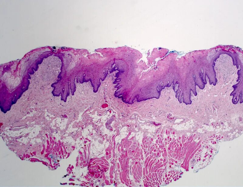 Красный плоский лишай вульвы фото Oral Hairy Leukoplakia (OHL, hairy leukoplakia, viral leukoplakia) - Cancer Ther