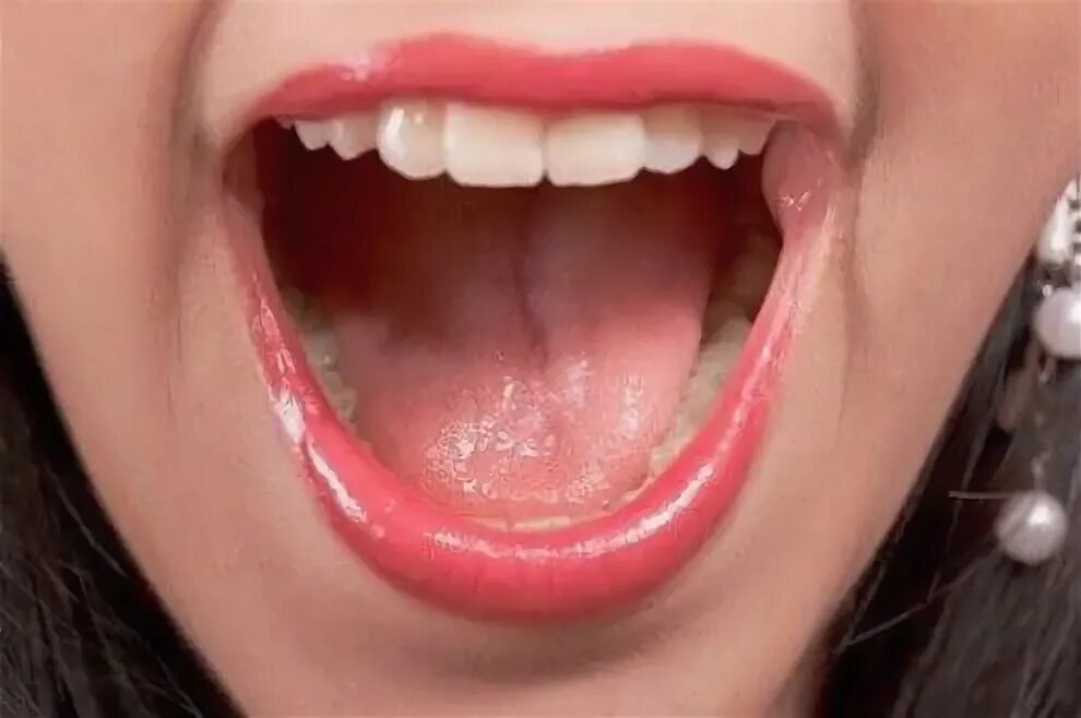 Красный плоский во рту фото If you're producing too much or too little saliva, your body could be trying to 