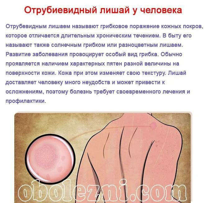 Красный розовый лишай фото Признаки стригущего лишая на голове и теле у ребенка с фото, методы лечения забо