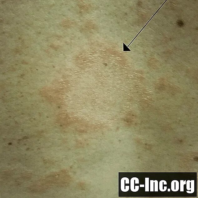 Красный розовый лишай фото Cara Mengenali Ruam Pityriasis Rosea - Obat - 2024