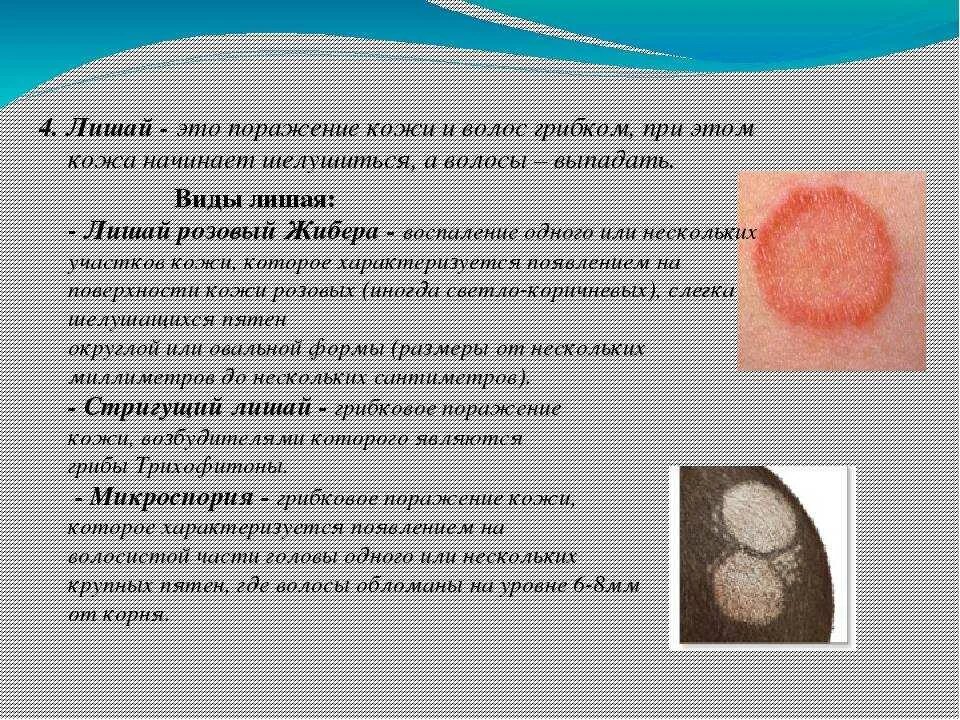 Красный розовый лишай фото Стригущий лишай у человека. симптомы, причины, лечение для взрослых и детей