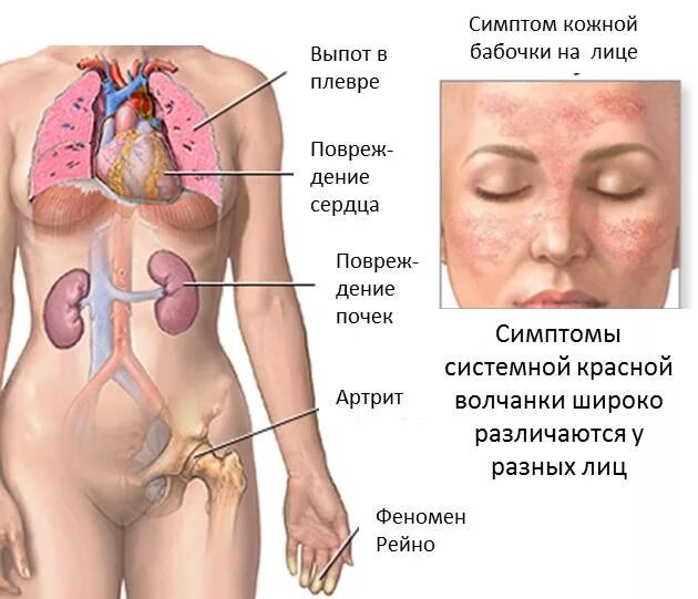 Красный волчанка болезнь симптомы фото Особенности течения системной красной волчанки и ее лечение