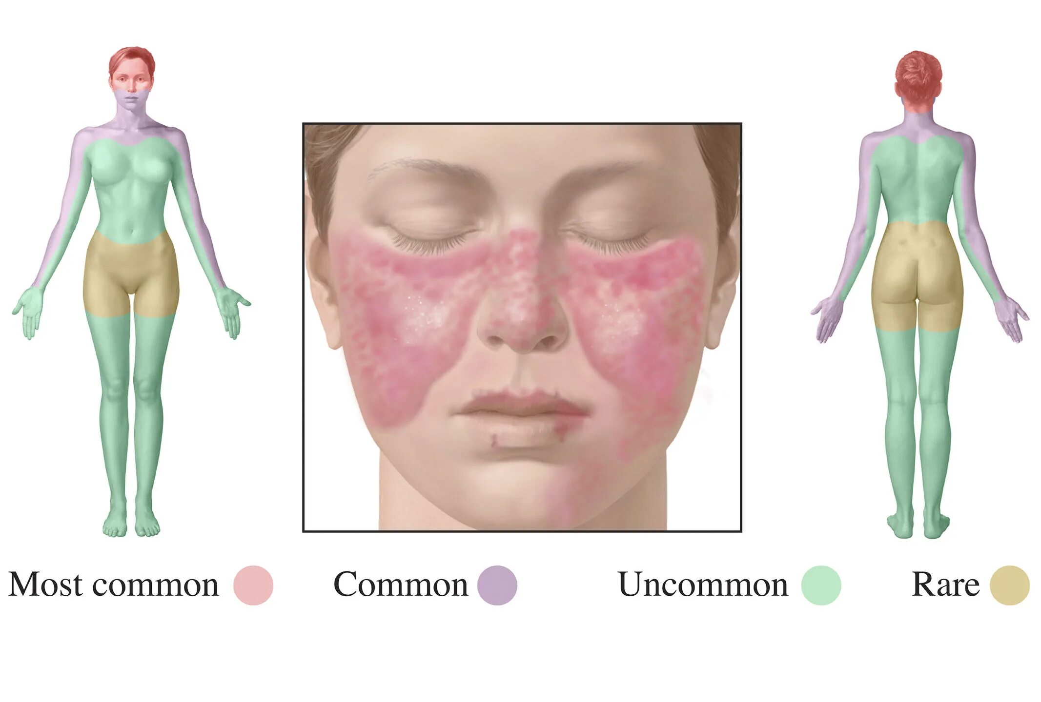 Красный волчанка болезнь симптомы фото A New Hope for Lupus Treatment CNRS News