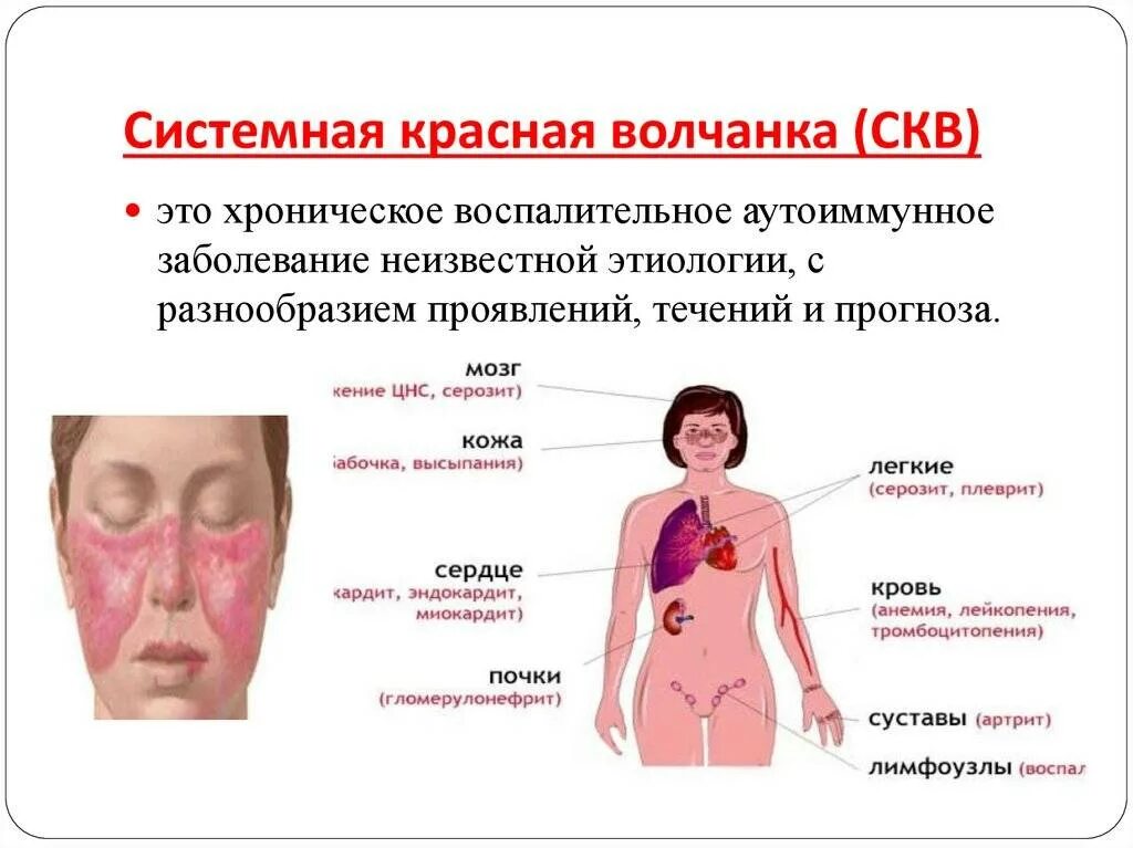 Красный волчанка болезнь симптомы фото Картинки СИСТЕМНАЯ КРАСНАЯ ВОЛЧАНКА ОТНОСИТСЯ