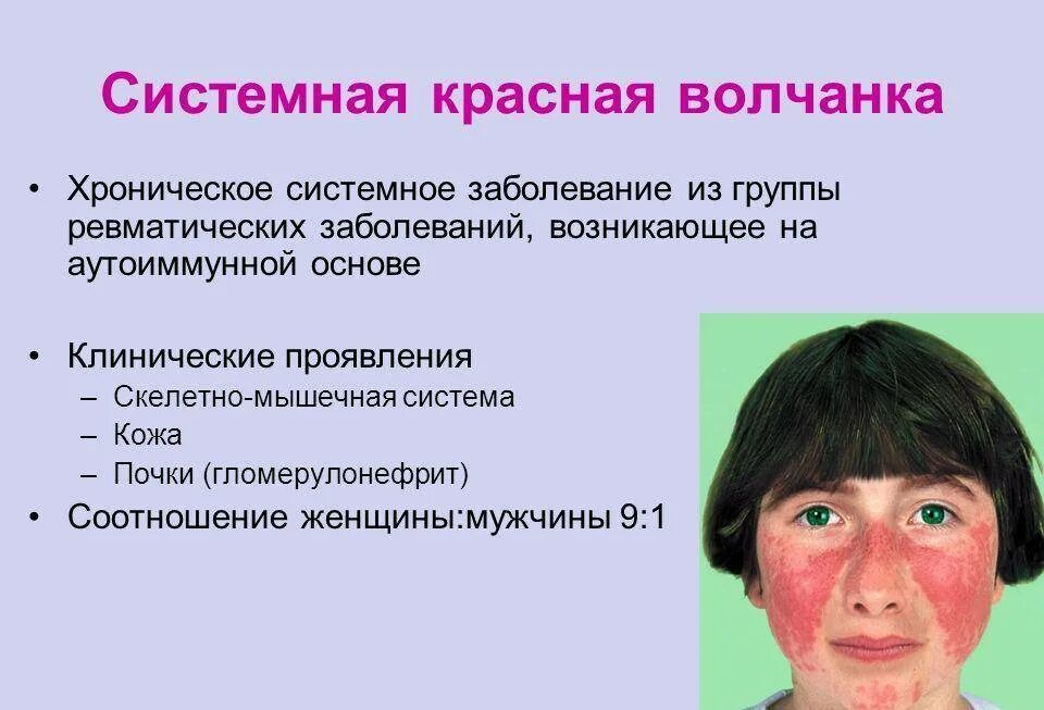 Красный волчанка болезнь симптомы фото Красная волчанка что это простыми словами