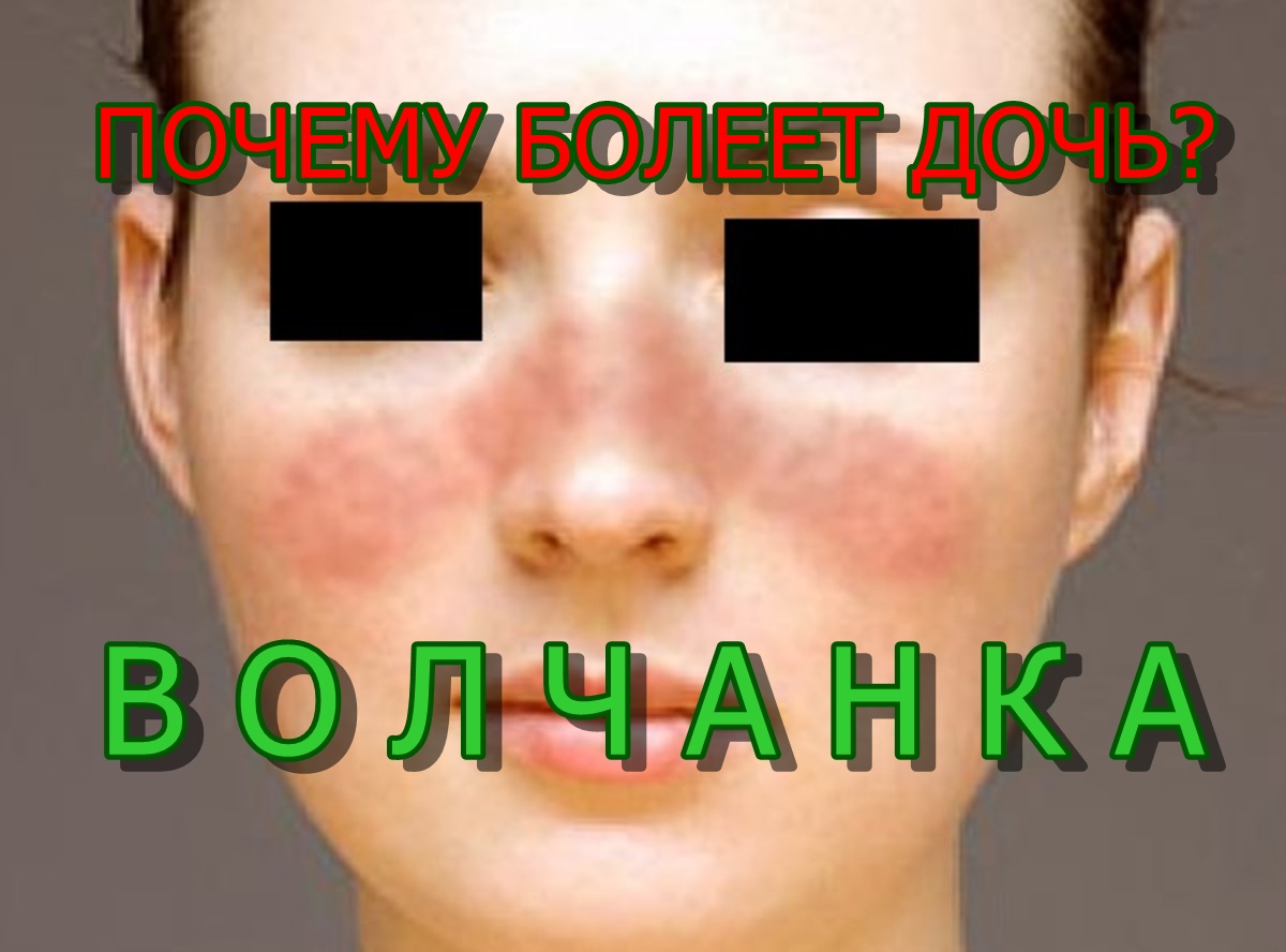 Красный волчанка болезнь симптомы фото ПОЧЕМУ БОЛЕЕТ ДОЧЬ ВОЛЧАНКА. WHY DOES A DAUGHTER SICK LUPUS. KODĖL dukra serga -