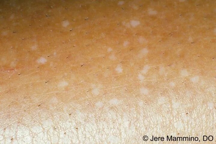 Красный волосяной лишай девержи фото Idiopathic Guttate Hypomelanosis White skin spots, Skin spots, Skin