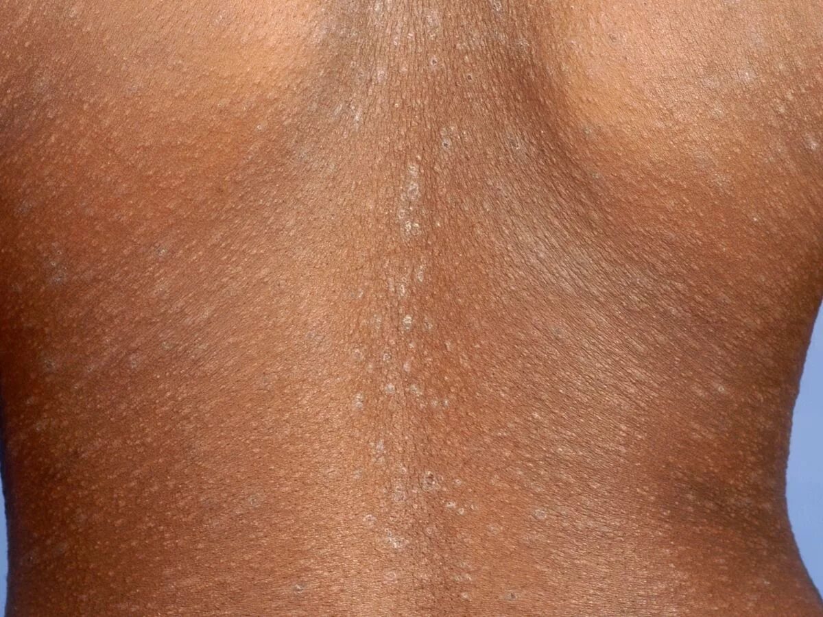 Красный волосяной лишай девержи фото Pityriasis rosea (patientenfolder)
