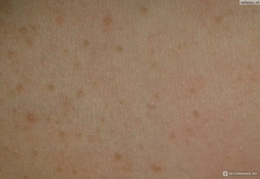 Красный волосяной лишай девержи фото Гель-скраб для тела Salon spa collection Гель - пилинг для душа - "Аллергия и те