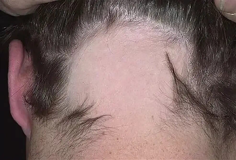 Красный волосяной лишай фото Alopecia Areata Causes, Regrowth Signs, Symptoms & Treatment