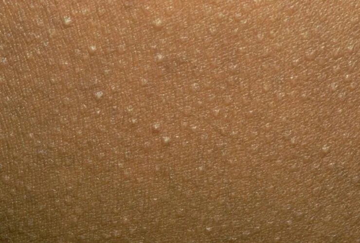 Красный волосяной лишай фото The Fastest Ways to Get Rid Of Zits, Ingrown Hairs, and 5 Other Annoying Skin Pr