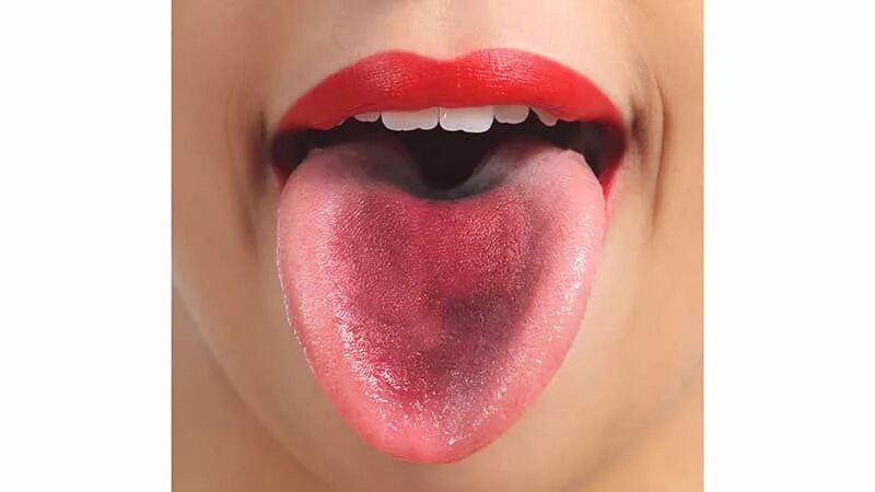 Красный язык фото Коричневый налет на языке: причины, симптомы, лечение