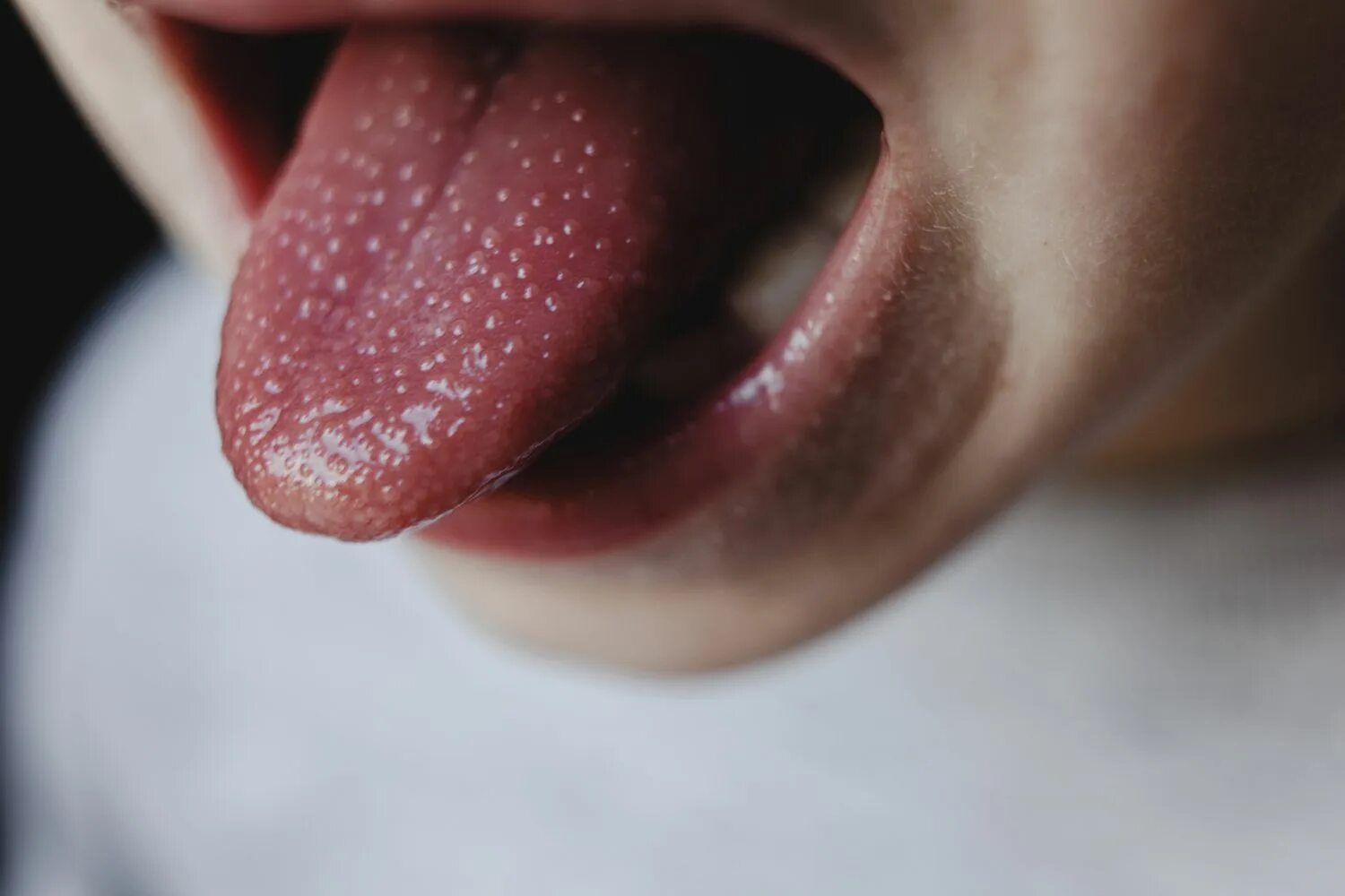 Красный язык причины у взрослого фото Strawberry Tongue: Symptoms, Causes, and Treatment